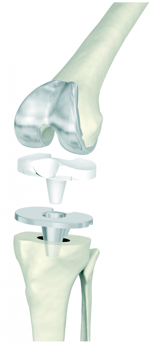 Totale Knie Prothese Orthopedisch Centrum Limburg totale-knie-prothese-orthopedisch-centrum-limburg